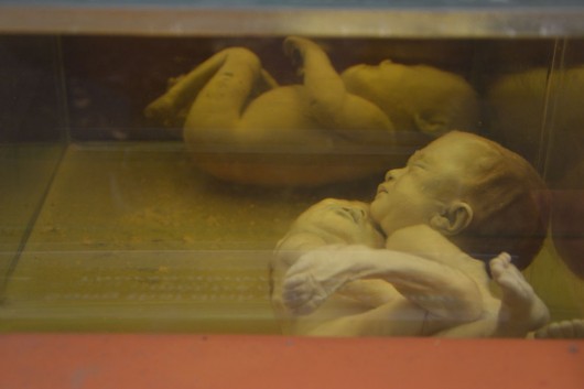 Unborn deformed babies on display at the war museum
